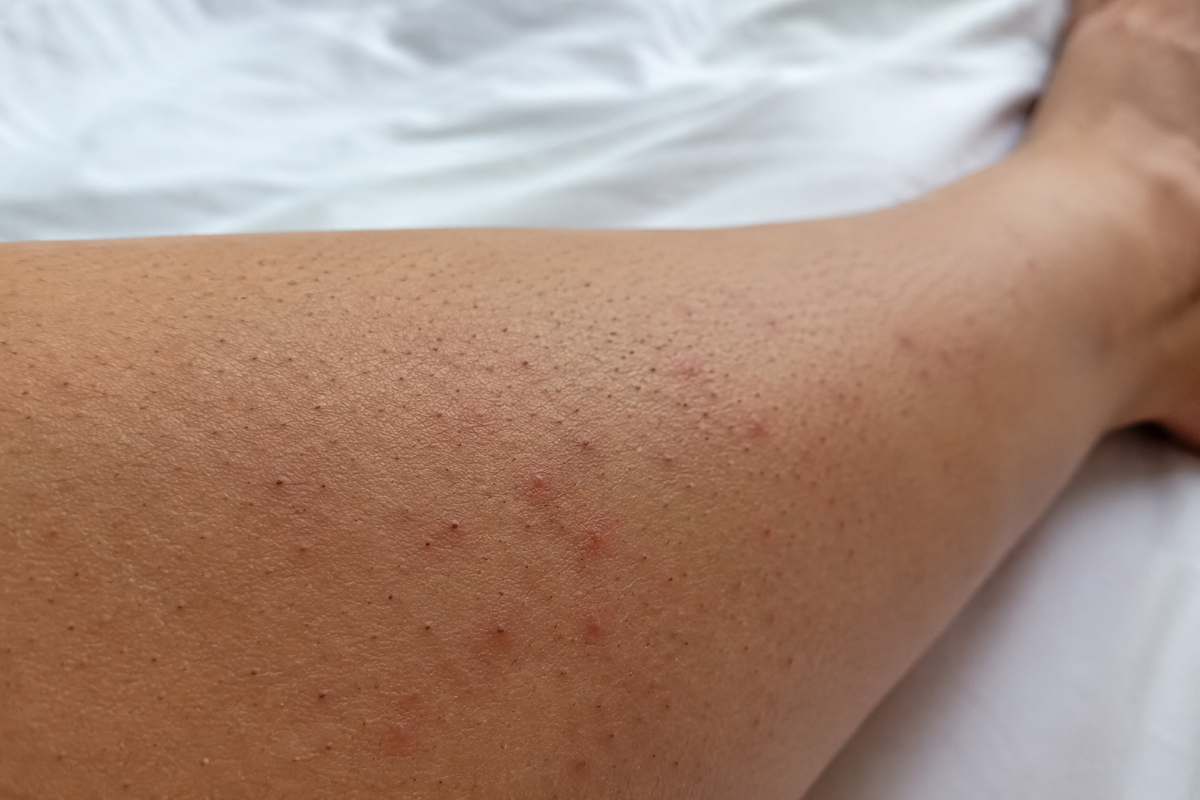 Woman's leg with ingrown hair.