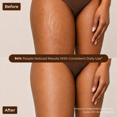Brown Butters Caramel Latte duo before and after thighs: stretch marks, then smoother skin, 94% noticed.