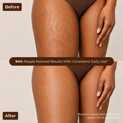 Brown Butters Caramel Latte Trio before and after thighs showing faded stretch marks